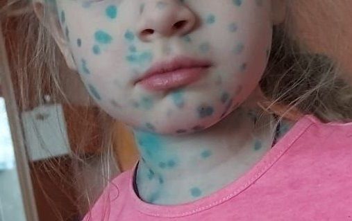 В России стремительно растет заболеваемость ветрянкой