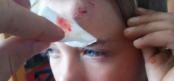 Ребенок получил травму головы, упав с оборвавшейся качели