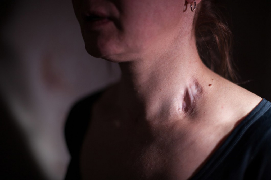 Шрам на шее Натальи Степановой от воспаления, полученного во время отбывания срока. Фото: Федор Телков, специально для «Новой газеты»
