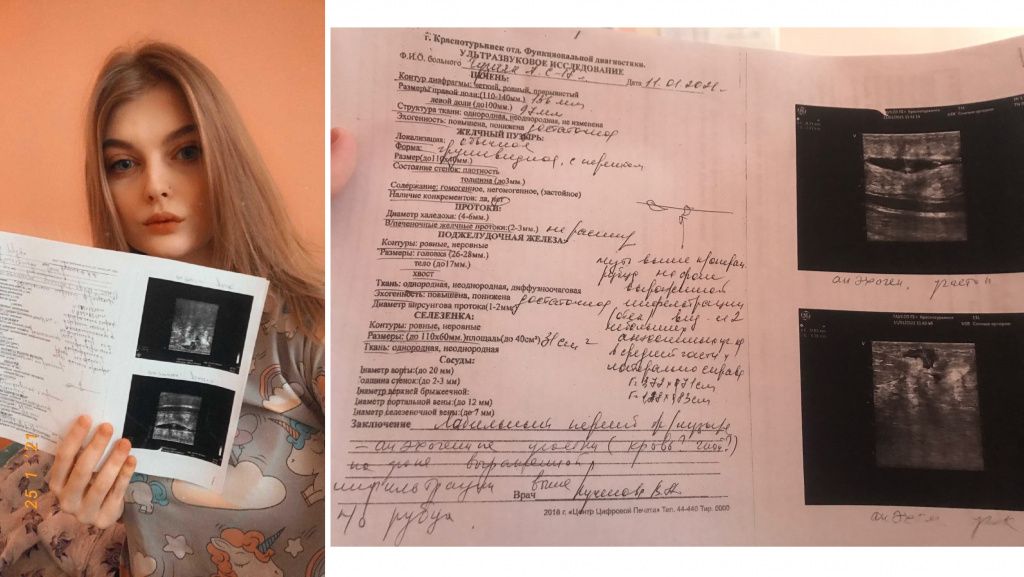 Анастасия Гузняк показывает результат УЗИ, на котором у нее обнаружили инфильтрат. Фотографии предоставлены Анастасией Гузняк.