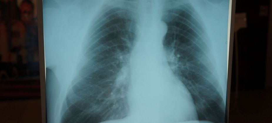 Флюорография выявила 12 случаев активного туберкулеза 