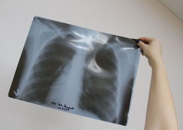 За год флюорография помогла выявить в Краснотурьинске три случая активного туберкулеза