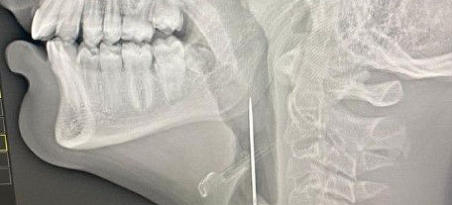 В Краснотурьинске врачи помогли мальчику из Карпинска, в дыхательные пути которого попала игла